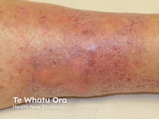 Venous eczema