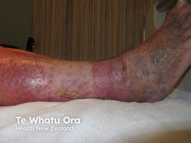 Venous eczema