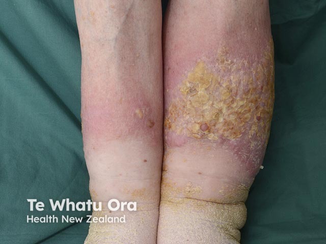 Venous eczema