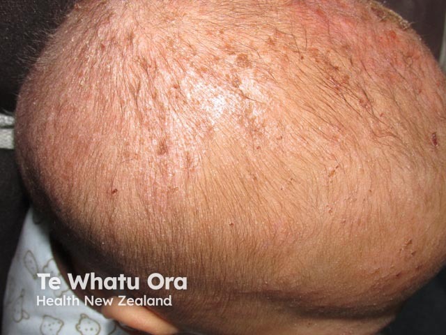 Seborrhoeic dermatitis