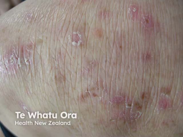 Dermatitis herpetiformis