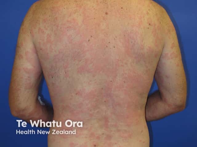 Urticaria