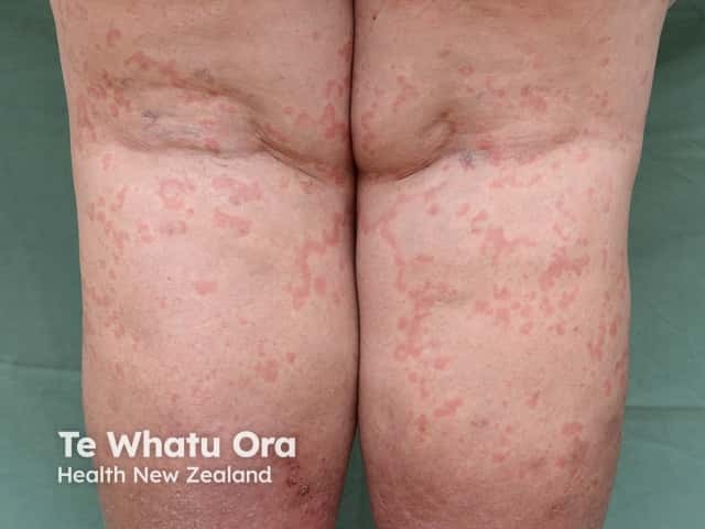 Urticaria