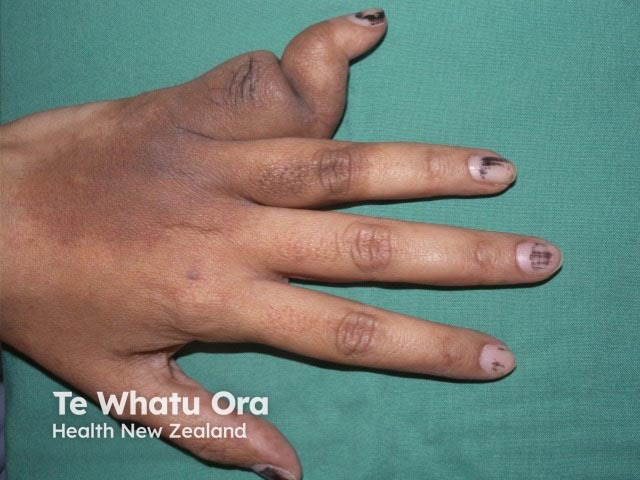 Neurofibromatosis