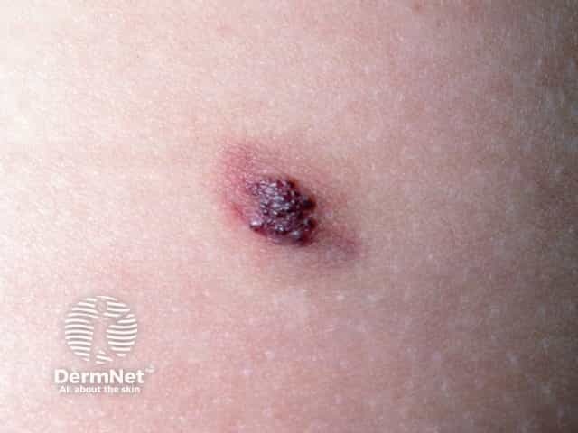 Thrombosed angiokeratoma