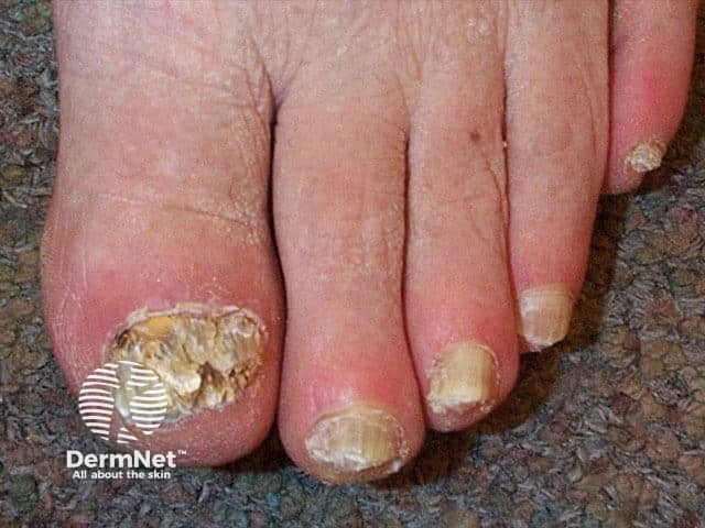 Tinea unguium, toenails