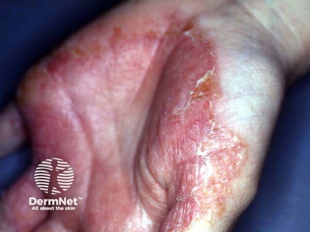 Zoophilic tinea infection