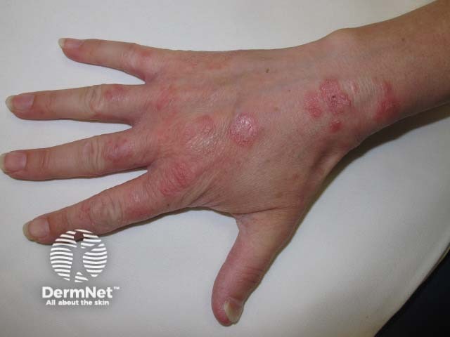 Chronic tinea infection