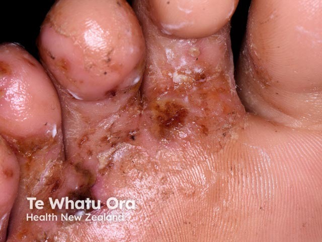 Tinea pedis