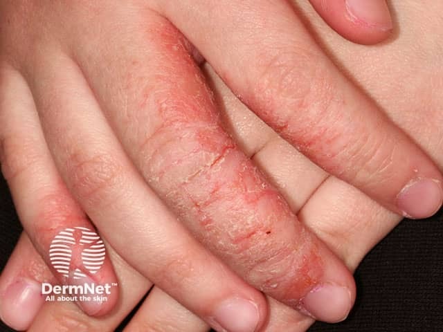 Atopic irritant hand dermatitis