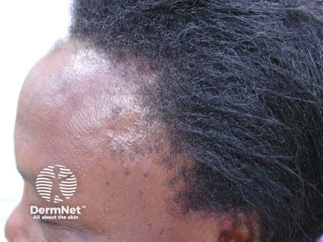 Traction alopecia