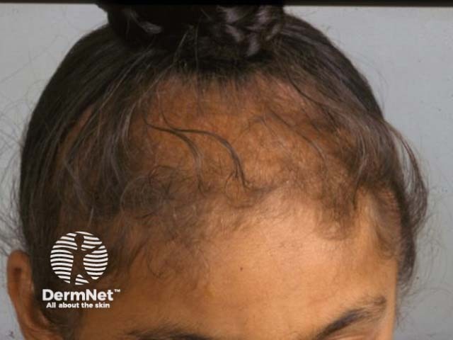 Traction alopecia