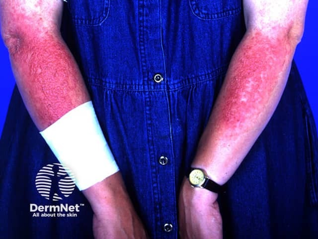 Sunscreen dermatitis