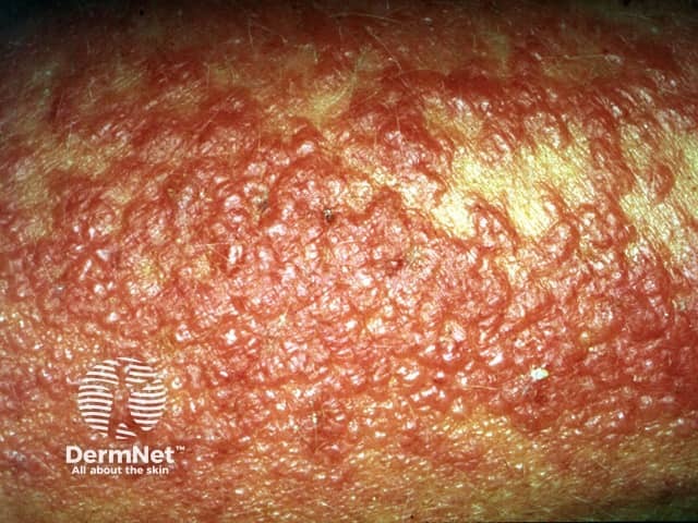 Sunscreen dermatitis