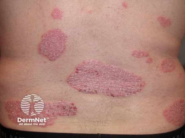 Psoriasis before commencing adalimumab