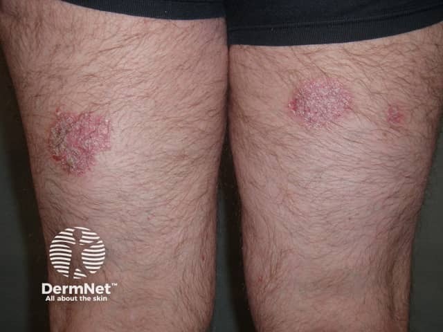 Psoriasis before commencing adalimumab