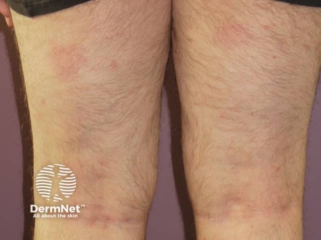 Psoriasis 6 months after commencing adalimumab