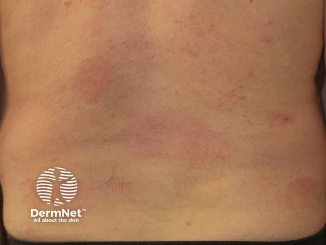 Psoriasis 6 months after commencing adalimumab