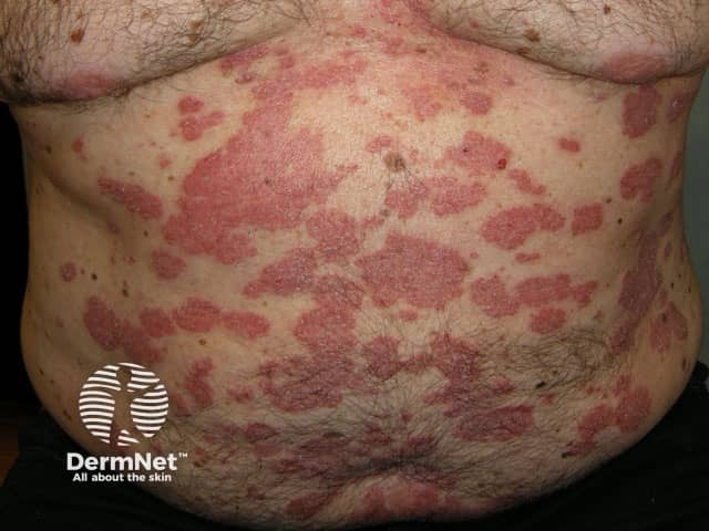 Psoriasis before commencing adalimumab