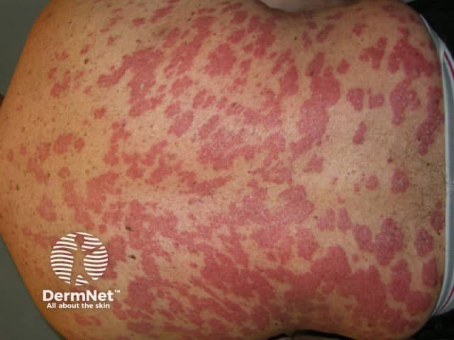 Psoriasis before commencing adalimumab