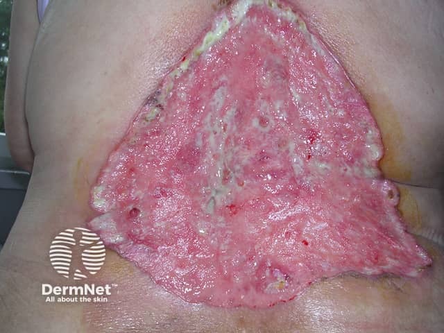 Advanced basal cell carcinoma