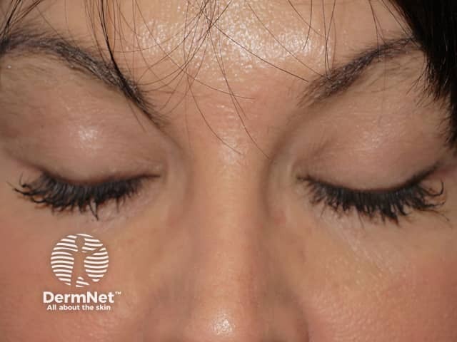 Effect of bimatoprost solution on eyelashes