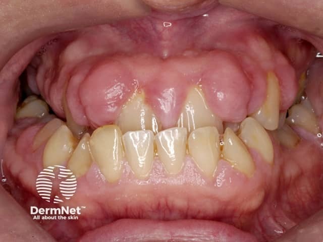 Gum hypertrophy due to ciclosporin