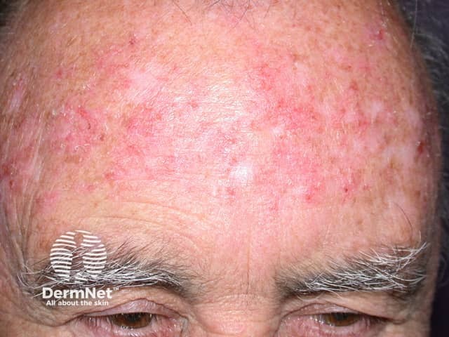 Imiquimod to actinic keratosis