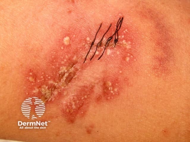 Localised pustular psoriasis