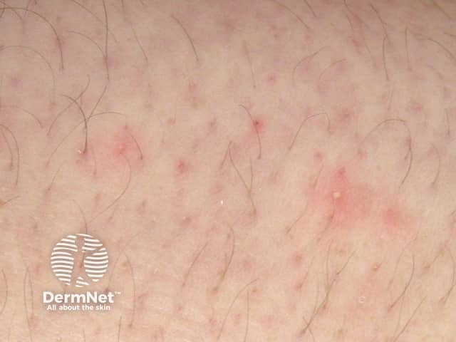 Folliculitis induced by sirolimus