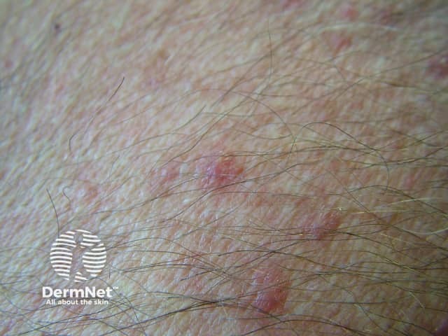 Folliculitis