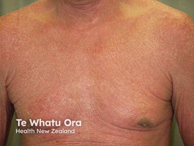 Erythrodermic psoriasis before ustekinumab