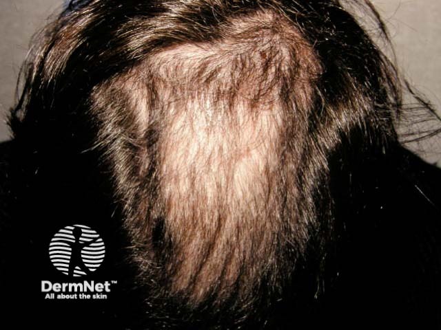 Trichotillomania