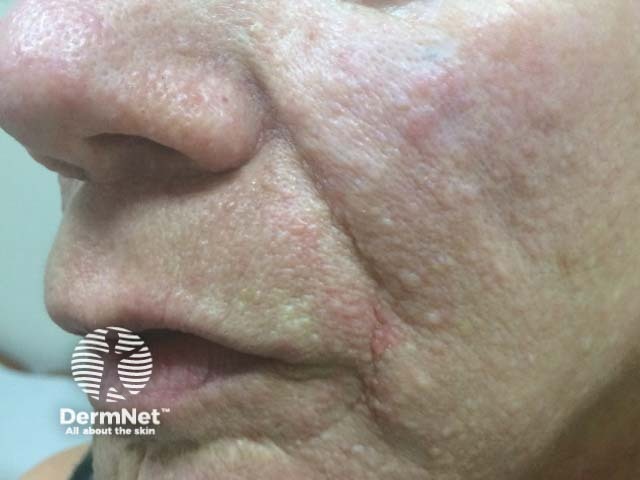 Angiofibromas in tuberous sclerosis