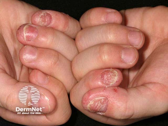 Twenty nail dystrophy