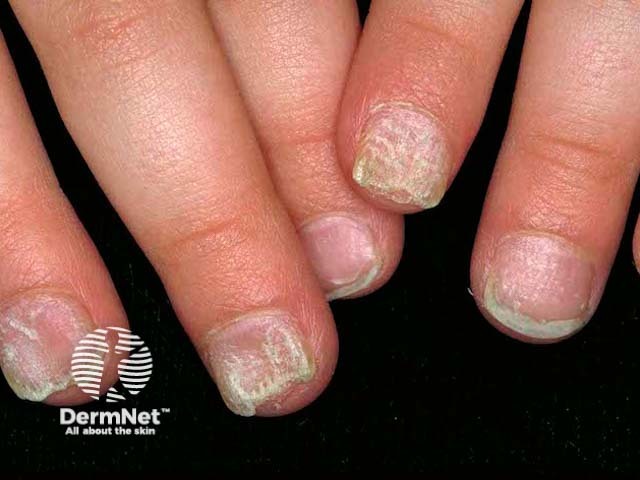 Twenty nail dystrophy