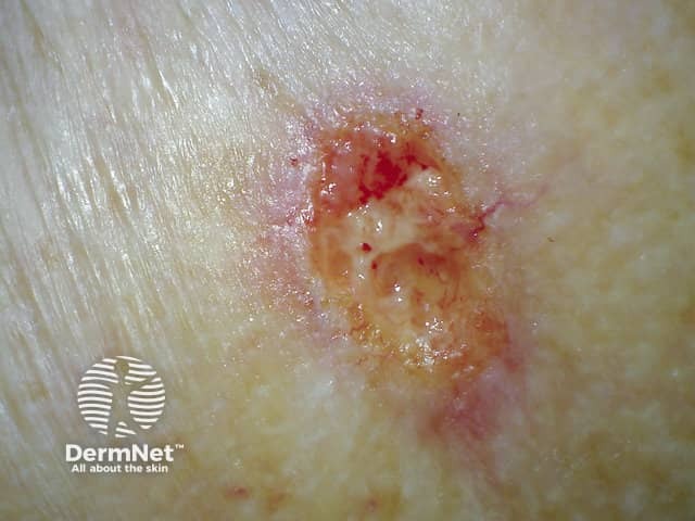 Ulcerating basal cell carcinoma, arm