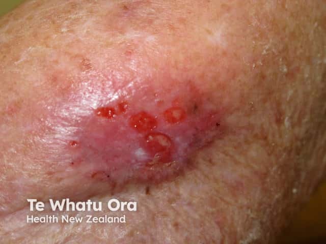 Ulcerating basal cell carcinoma, elbow