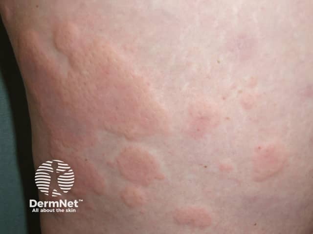 Spontaneous urticaria