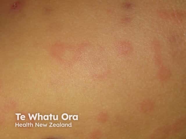 Spontaneous urticaria