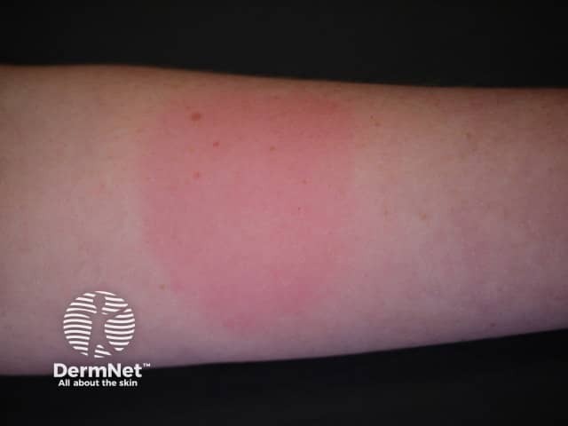 Diffuse weal from ice cube test in cold urticaria