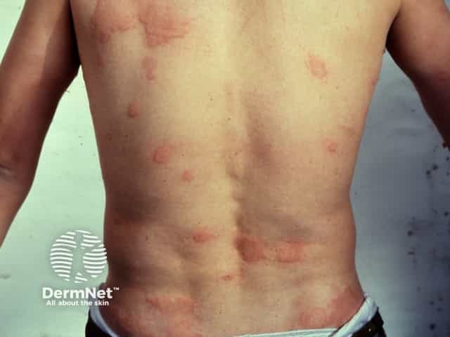 Urticaria