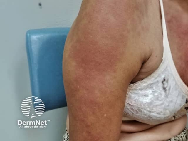 Acute urticaria