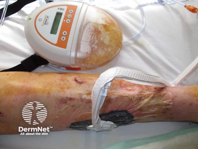 Wound undergoing treatment with negative-pressure device