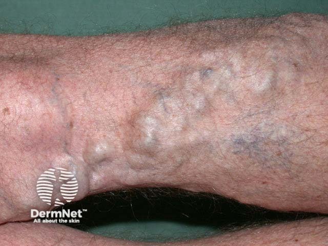 Varicose veins