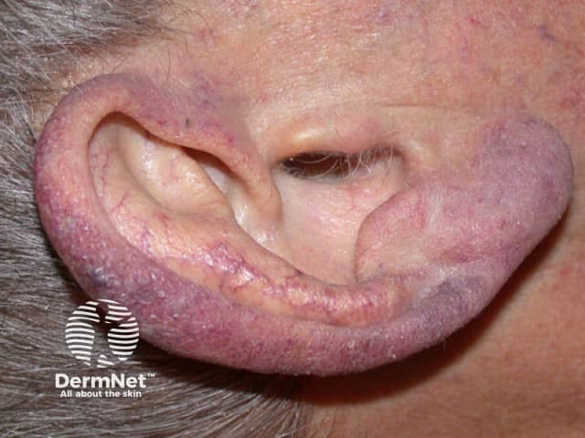 Secondary acrocyanosis