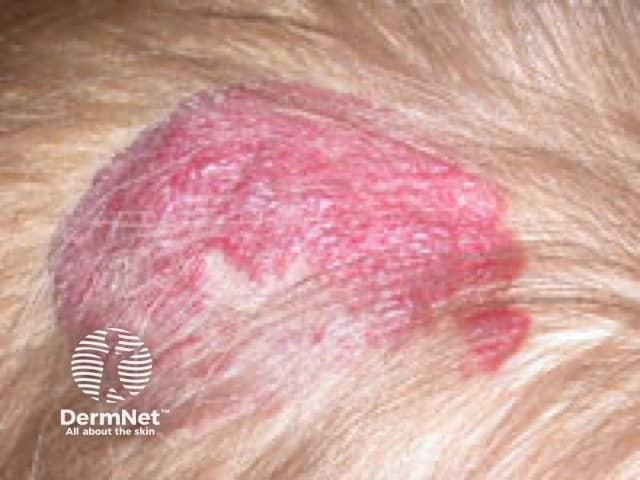 Regressing infantile haemangioma, scalp