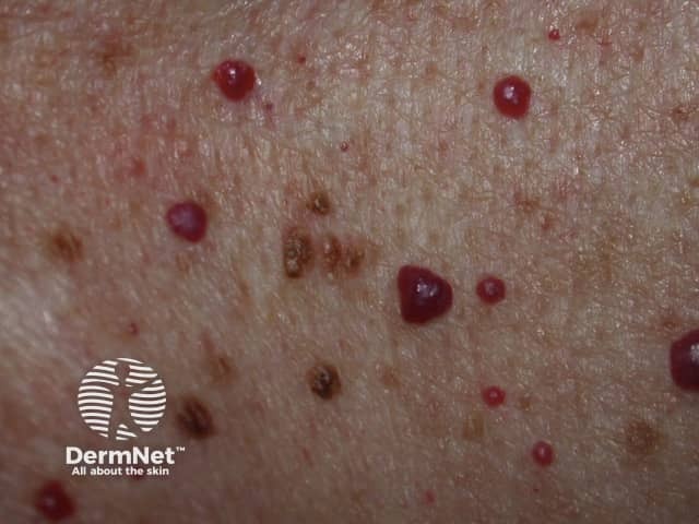 Cherry angioma