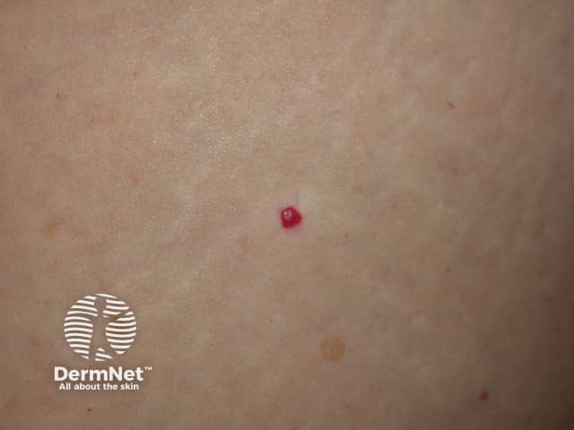 Cherry angioma