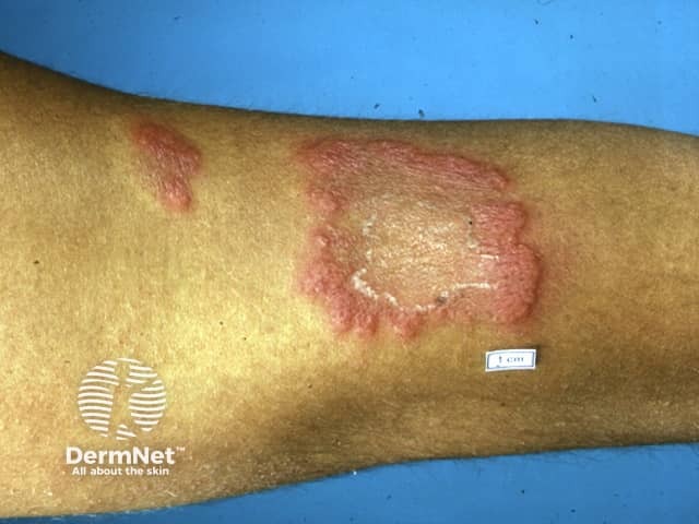 Erythema elevatum diutinum